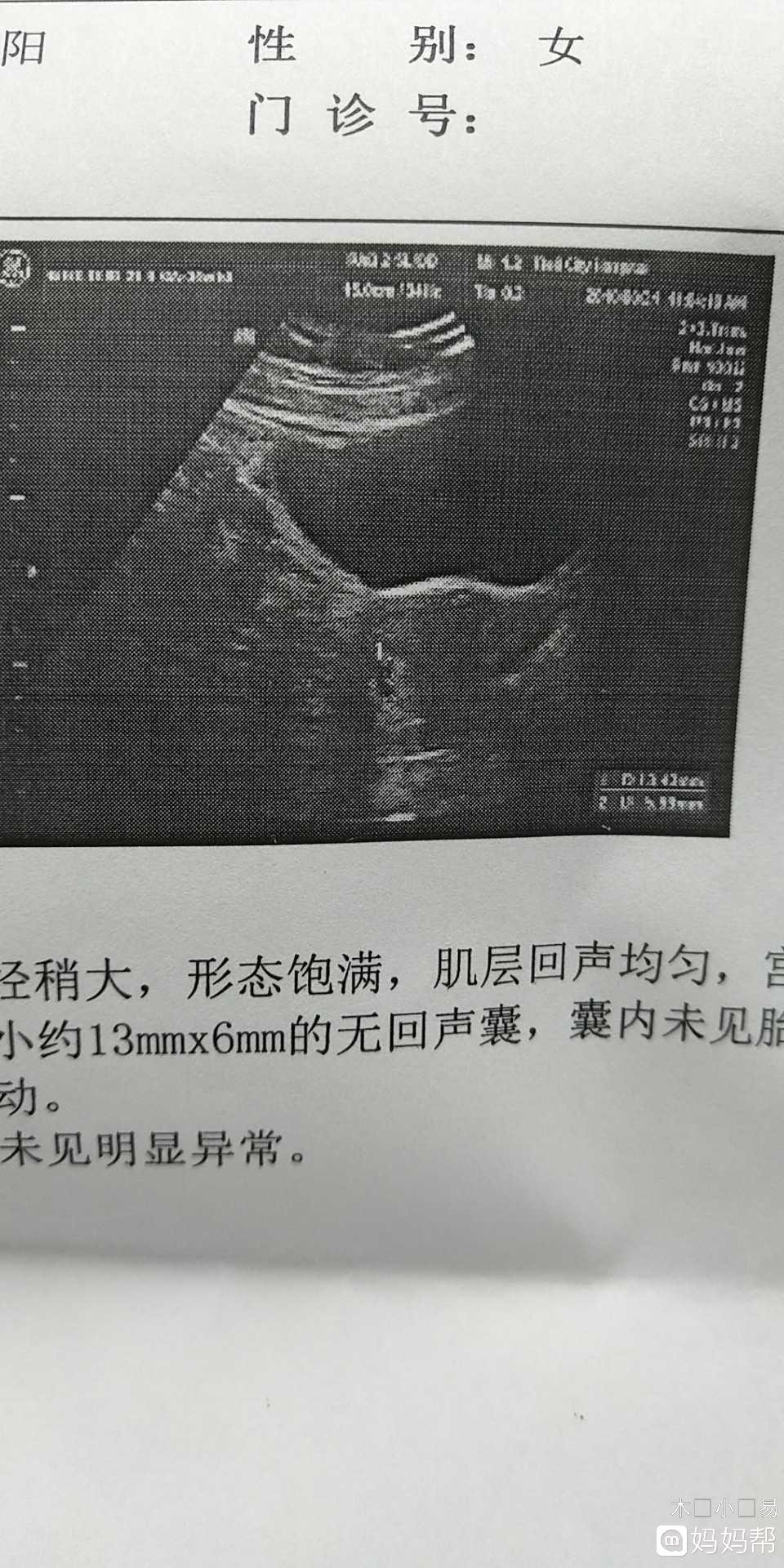 供卵试管婴儿取卵前B超可以看到空卵泡吗？