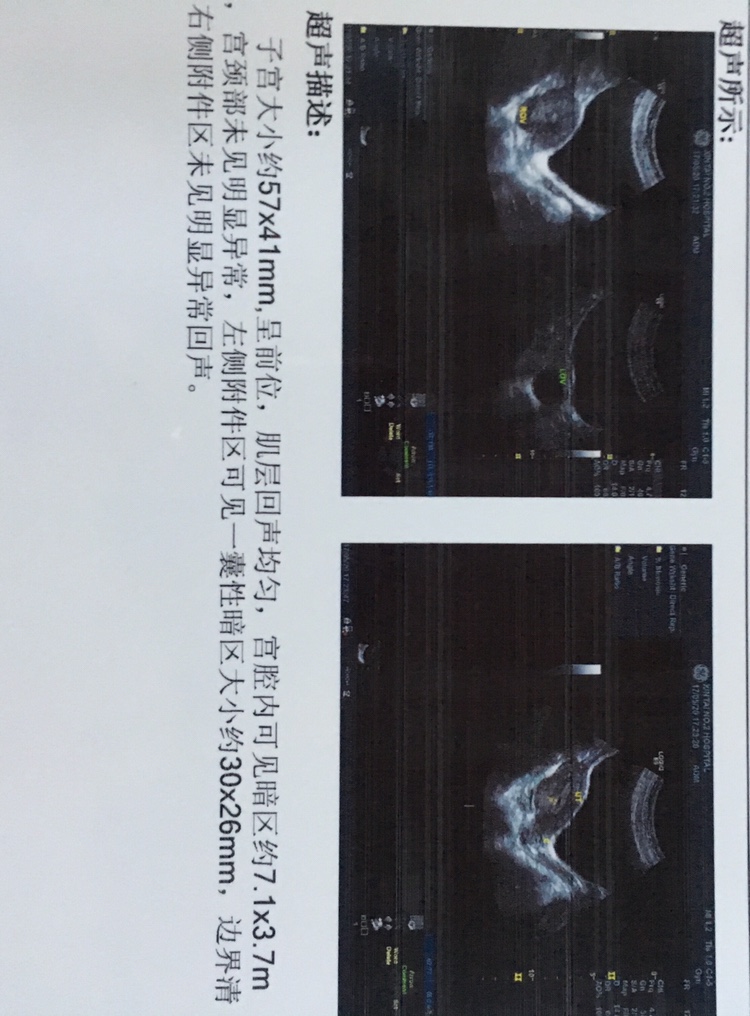 借卵做试管代生借用卵子的费用是多少
