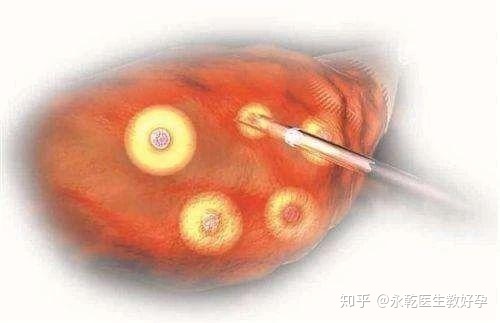 你知道如何阅读FSH值吗？高的FSH值对赠卵私立代生试管有什么影响？