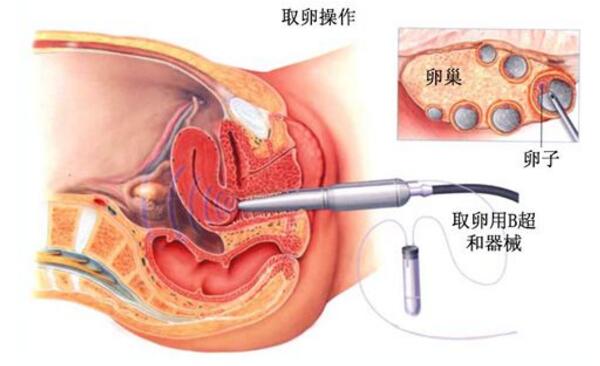 苏州最出名供卵试管医院
