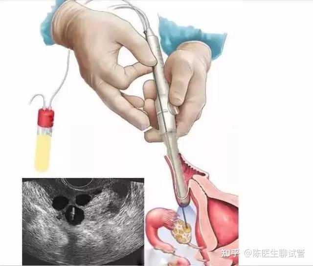 供卵代生宝宝技术如何降低风险