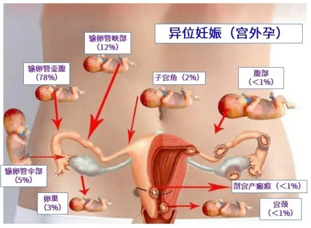 前列腺增生伴结石如何除“顽石”