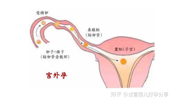 amh低怎么办+生活习惯因素造成的+这4个方法可帮助提高