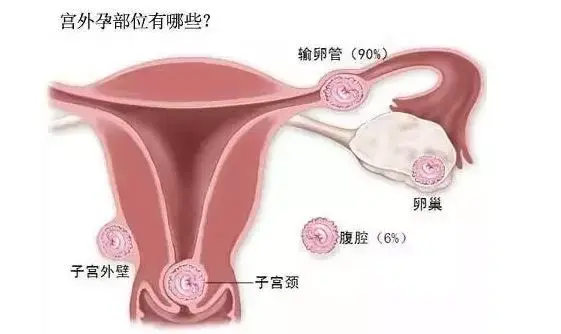 代生孩子微信收针是什么